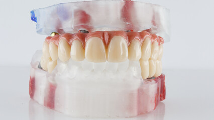 temporary dental prosthesis of the upper jaw and bridges on the model, on a white background © Dental Pro Content