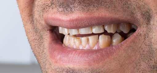 dental job photography, crowns veneers implants

