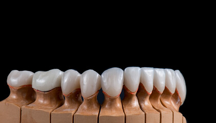 dental job photography, crowns veneers implants
