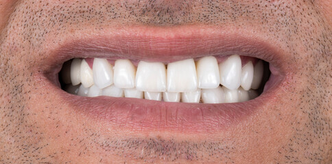 Obraz premium dental job photography, crowns veneers implants 