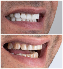 Obraz premium dental job photography, crowns veneers implants 