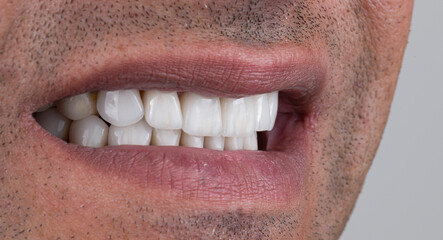 Obraz premium dental job photography, crowns veneers implants 