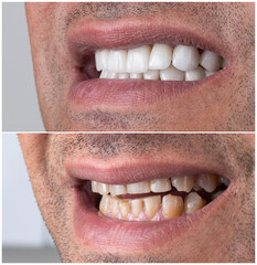 Obraz premium dental job photography, crowns veneers implants 