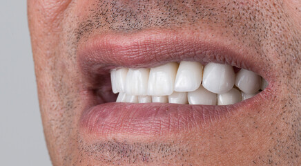 Obraz premium dental job photography, crowns veneers implants 