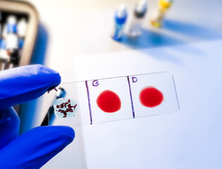 A Negative (-ve) blood type, one of the rare blood group in worldwide. Blood group and Rh factor testing by slide agglutination method.