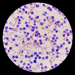 Buffy coat smear shows marked eosinophilia. Eosinophils are a type of disease-fighting white blood...