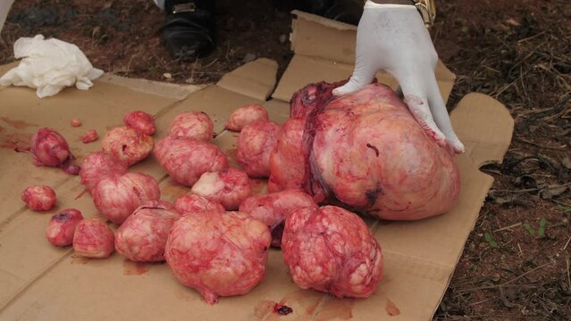 video of fibroid