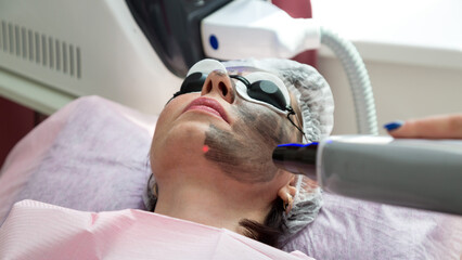 Spa salon client woman carbon laser peeling procedure.