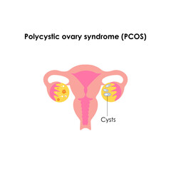 female uterus and ovaries.Polycystic ovarian syndrome.