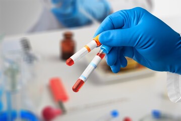 A disease blood test in doctor hand on the background