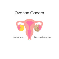 Anatomical drawing. Ovarian cancer.
