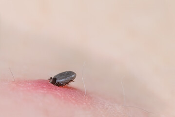 Female deer tick nymph bitten in pink irritated skin. Ixodes ricinus. Fattened parasitic mite sucking blood on a human body detail. Close-up of small parasite, carrier of encephalitis or Lyme disease.