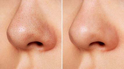 Close-up of woman's nose with blackheads before and after peeling and cleansing the face. Acne problem, comedones. Getting rid of black dots. Cosmetology dermatology concept - obrazy, fototapety, plakaty