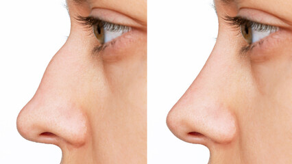 Profile of woman's face with nose before and after rhinoplasty isolated on white background. The result of cosmetic plastic surgery on the nose. Correction of the nasal septum. Getting rid of the hump - obrazy, fototapety, plakaty