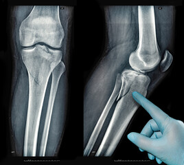 Xray images showing real fracture of leg bone under the knee after injury
