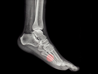 an x-ray of a human metatarsal bone fracture