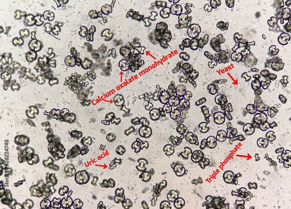 Poster Microscopic image showing calcium oxalate monohydrate, uric acid crystals and triple phosphate crystals from urine sediment. UTI. kidney disease.