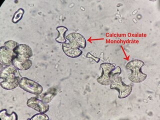 Microscopic image showing calcium oxalate monohydrate crystal from urine sediment. kidney disease....