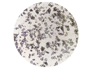 Microscopic image showing calcium oxalate monohydrate, uric acid crystals and triple phosphate crystals from urine sediment. UTI. kidney disease.