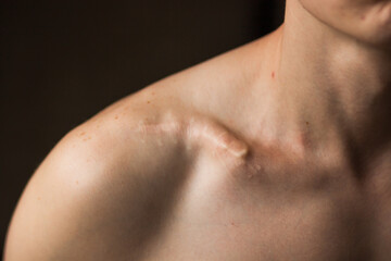 Close-up of man's collarbone injury. Black background. Injured athlete after successful fractured clavicle bone surgery. - obrazy, fototapety, plakaty