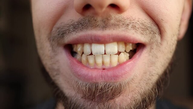 Close up of young man's face with crooked teeth. Teeth before install braces.