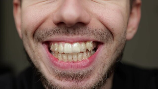 Close-up of a man with beard showing teeth at camera, Elasticated invisible braces set for teeth alignment and bite. 