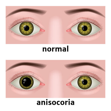 anisocoria. abnormally dilated pupil of the eye. Ophthalmic diseases. Medical poster. preliminary illustration