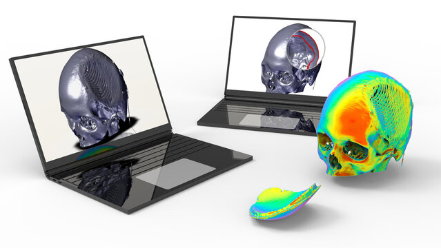 3D render - finite element analysis of a skull prothesis design