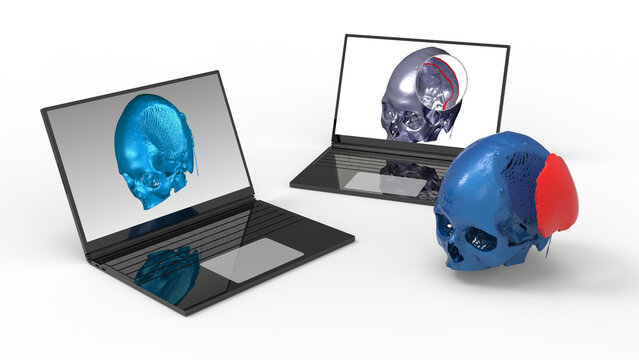 3D rendering - design a skull prothesis on a computer