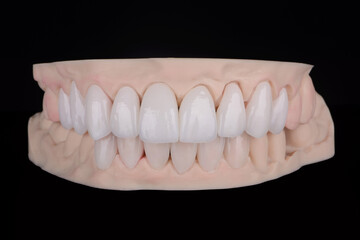 Quality dental prosthesis made of titanium beam and ceramics for fixation to the upper jaw. Teeth...