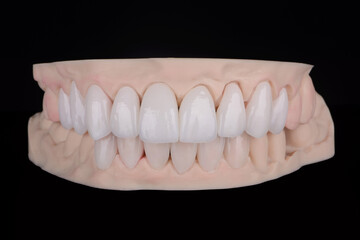 Quality dental prosthesis made of titanium beam and ceramics for fixation to the upper jaw. Teeth treatment.