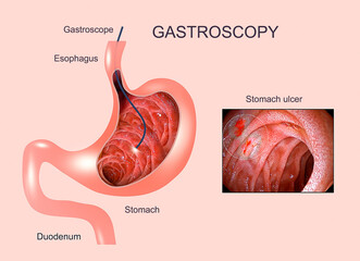 Digestive endoscopy or gastroscopy. Performing a gastroscopy procedure. Diagnostics of gastric diseases. Stomach health. Medical concept