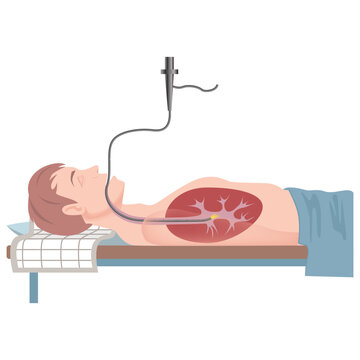 Bronchoscopy. The patient is in the supine position. Medical examination. Vector flat illustration