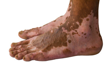 Close up of both feet were burning wound healed scarring unusual pattern.