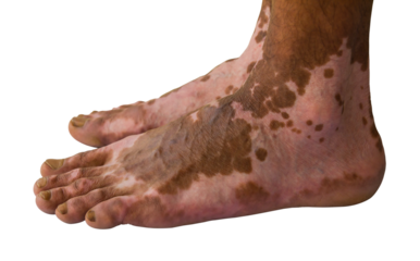 Close up of both feet were burning wound healed scarring unusual pattern.