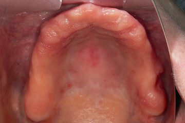 gum cavity of the upper jaw before total implantation, view through the mirror