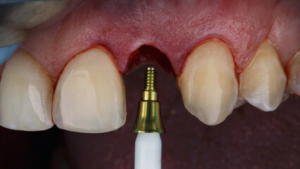 dental abutment before installation in the implant