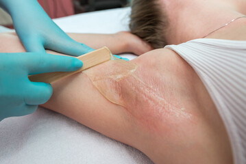 Depilation and epilation of the female armpit with liquid sugar paste. The beautician's hand applies wax paste to the armpit.