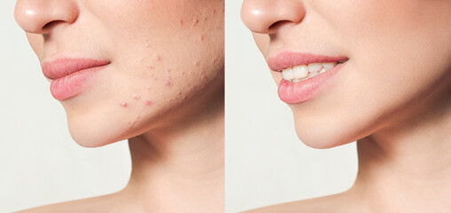 Teenage girl before and after acne treatment Skin care concept. Acne treatment in a cosmetology...