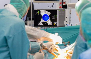 Team of doctor perform total hip arthroplasty replacement surgery in osteoarthritis patient inside the operating room. robot-assisted - robotic hip and knee replacement surgery  - obrazy, fototapety, plakaty
