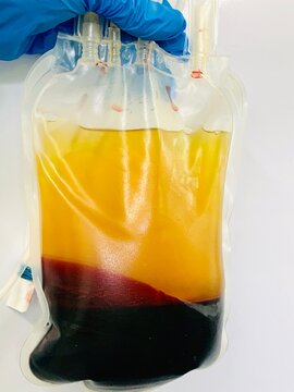 container with blood plasma and separated red blood cells. 