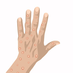 The hand of a person who got smallpox.