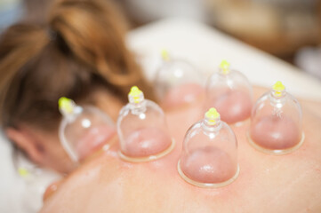 Glass vacuum cupping therapy on a woman's back, acupuncture treatment. Ventosa traditional massage....