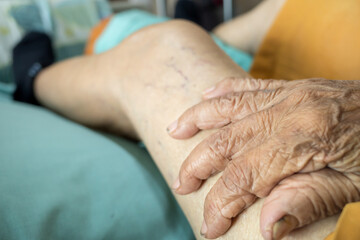 Wrinkled hand of senior patient holding thigh full of varicose veins on hospital bed - obrazy, fototapety, plakaty