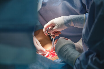 Closeup of doctors hands operating a patient conducting open cut surgery in surgical room....
