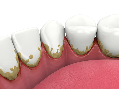 3d render of lower jaw with calculus buildup on teeth line and making inflammation