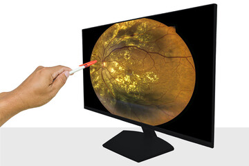 View inside human eye disorders showing retina, optic nerve and macula Severe age-related macular...