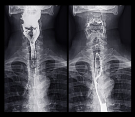 Barium Swallow study test diagnose Barrett's GI tract exam GERD ulcers series difficulty pharynx...