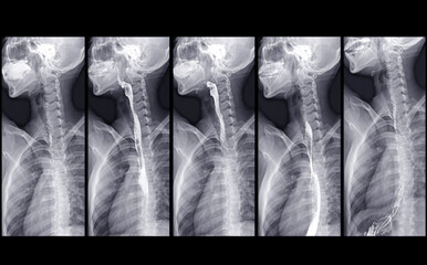 Barium Swallow study test diagnose Barrett's GI tract exam GERD ulcers series difficulty pharynx...