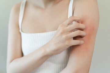 Sensitive skin allergic concept, Woman itching on her arm have a red rash from allergy symptom and...